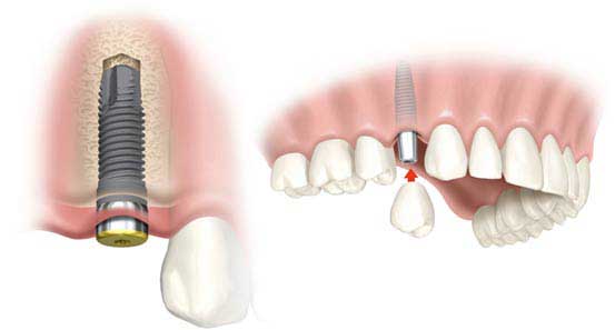 dental-implant-procedure